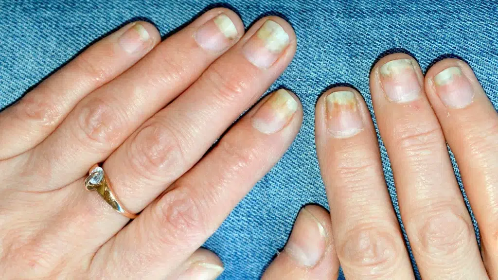 Psoriáza nehtů v kombinaci s psoriatickou artritidou prstů

Title: Psoriatická artritida a nehty