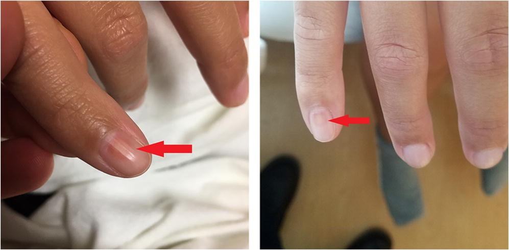 Psoriáza nehtů – olejové skvrny (oil spots) pod nehtovou ploténkou