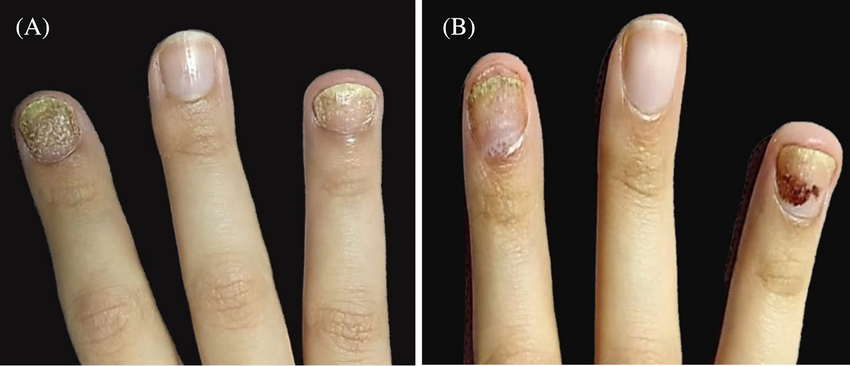Psoriáza nehtů – ztluštění nehtové ploténky (hyperkeratóza)