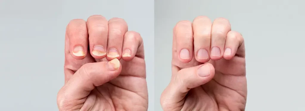 Srovnání zdravého nehtu a nehtu postiženého psoriázou