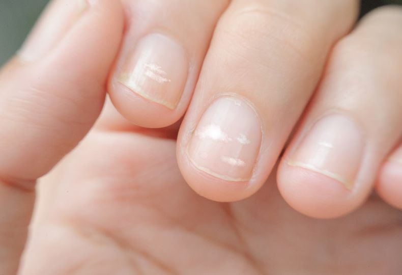 Leukonychie – bílé skvrny na nehtech způsobené drobným poraněním nehtové ploténky