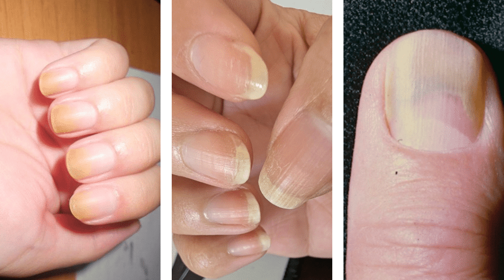 Syndrom žlutých nehtů – příklad žlutého zbarvení a zpomaleného růstu nehtů na rukou a palci u nohy